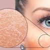 How To Prevent Skin Purging? The Dos and Don'ts