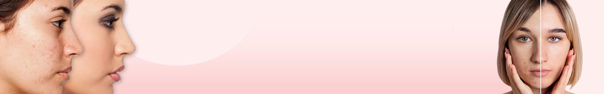 Acne-Prone Skincare Products | Collection Banner Acne-Prone Skincare Products | Collection Banner