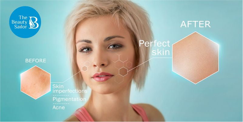 Acne Causes And Treatments