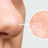 Remove Blackheads And Whiteheads On Nose: Expert Tips